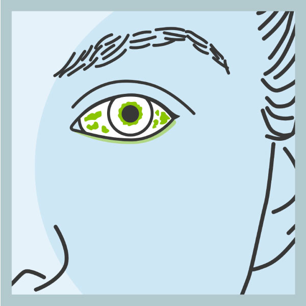 Zum Welttag des Sehens: Rechtzeitig erkannt ist Uveitis gut behandelbar!