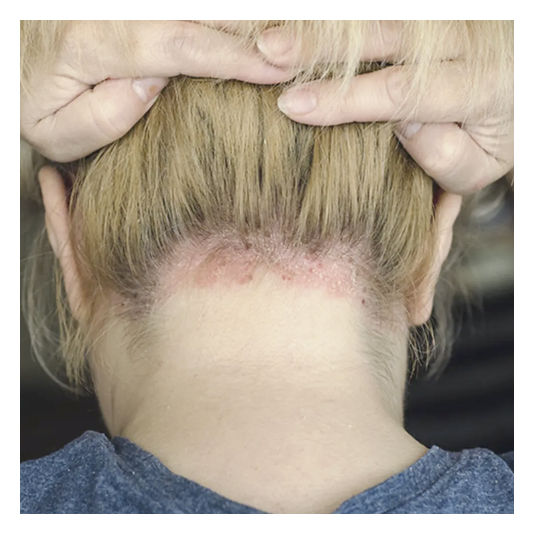 Welt-Psoriasis-Tag 2022: Mehr Aufklärung verhindert Isolation von Betroffenen